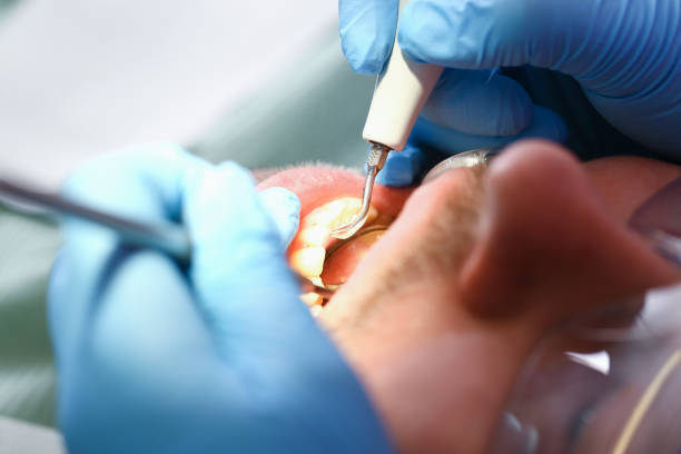 Best Emergency Wisdom Tooth Extraction in Mount Hermon, CA